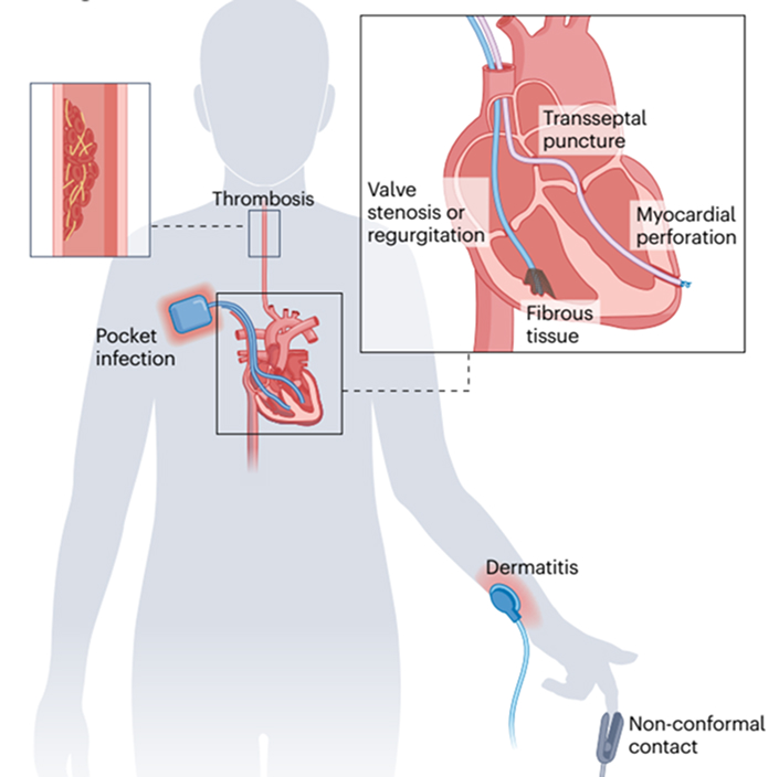 Wireless, Minimally-invasive, and Implantable Soft Bioelectronics